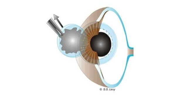 eye diagram depicting removal of diseased cornea by surgeon during cornea transplant surgery
